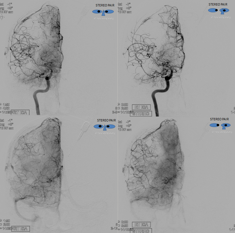 MMA recurrent meningeal fistula