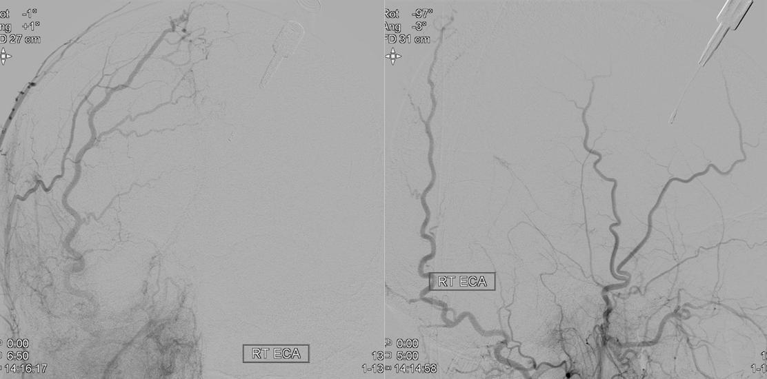 MMA recurrent meningeal fistula