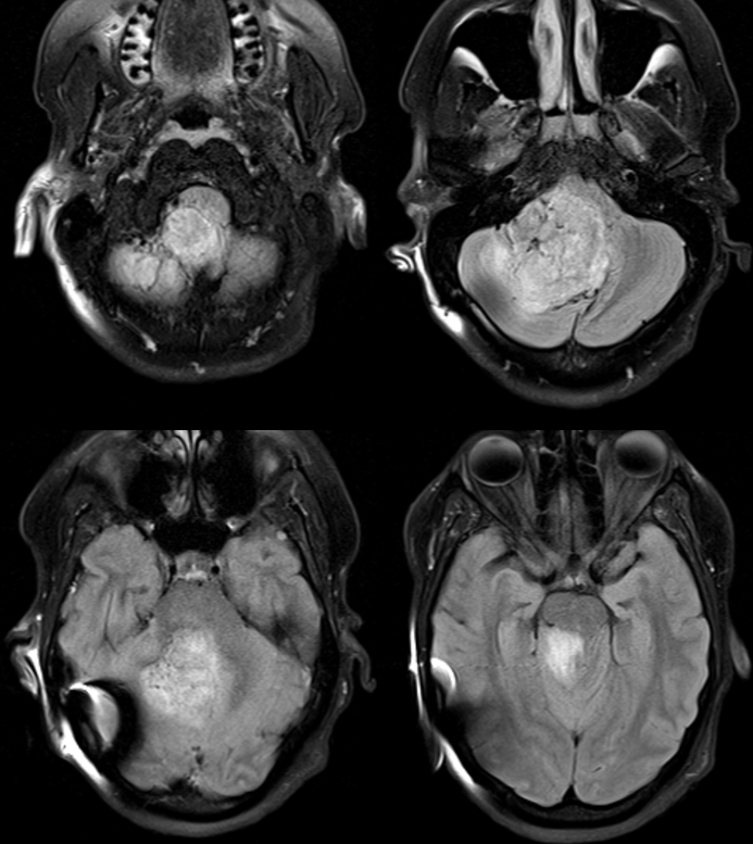 Hemangiopericytoma Embolization and Resection