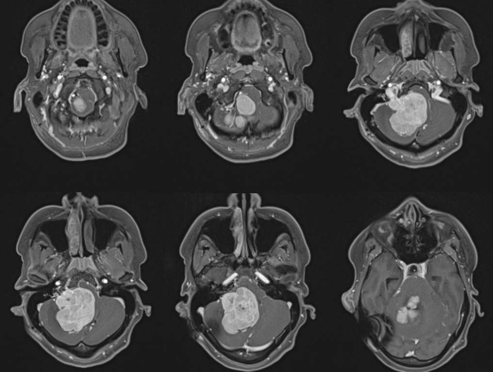 Hemangiopericytoma Embolization and Resection