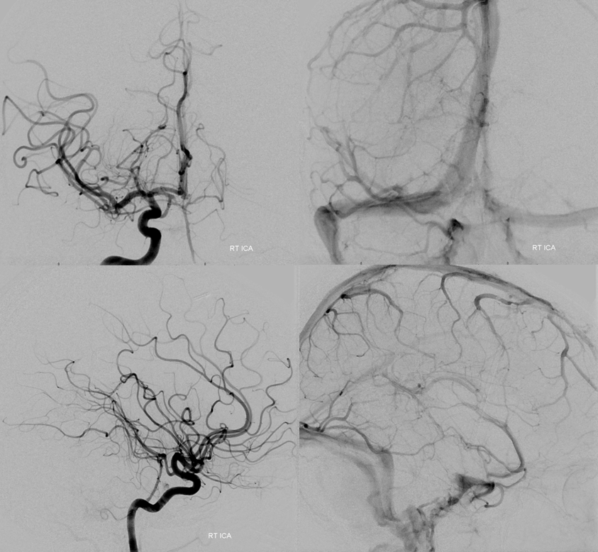 Hemangiopericytoma Embolization and Resection