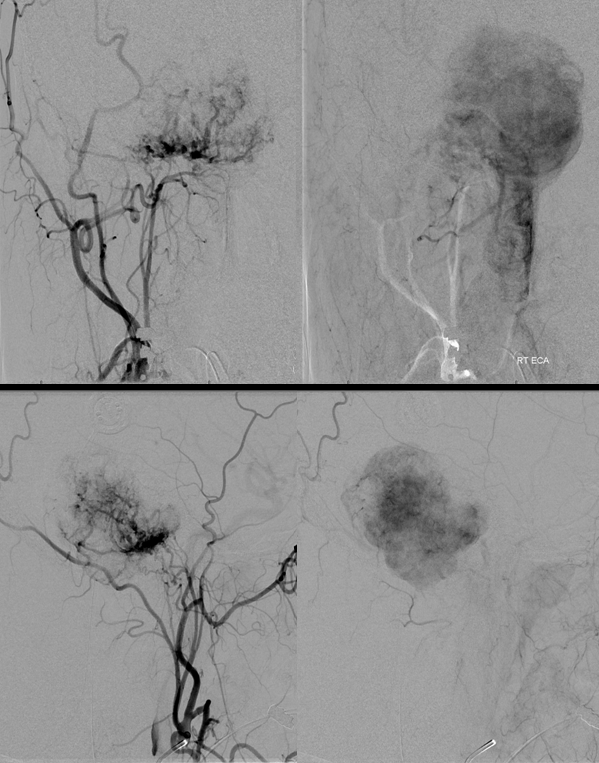 Hemangiopericytoma Embolization and Resection