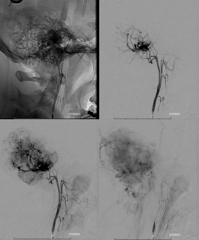 Hemangiopericytoma Embolization and Resection