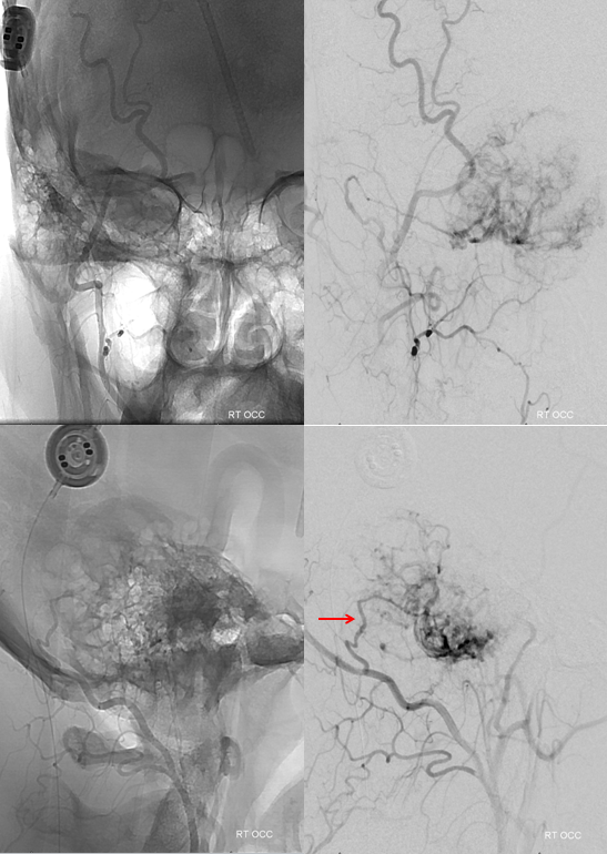 Hemangiopericytoma Embolization and Resection