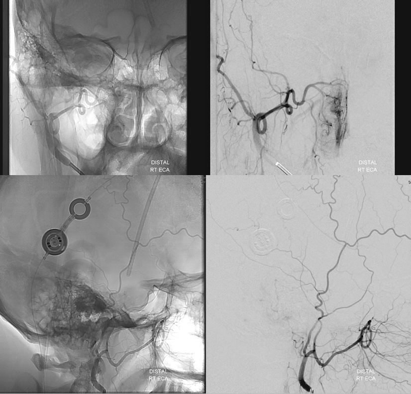 Hemangiopericytoma Embolization and Resection