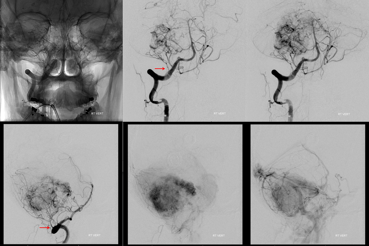 Hemangiopericytoma Embolization and Resection