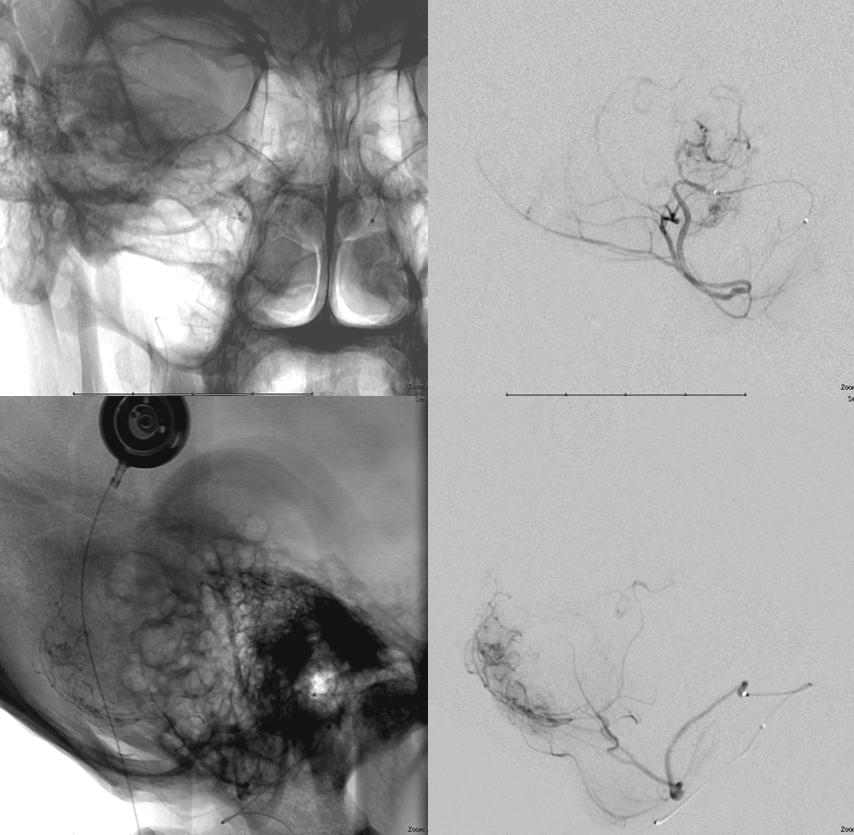 Hemangiopericytoma Embolization and Resection