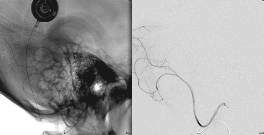 Hemangiopericytoma Embolization and Resection