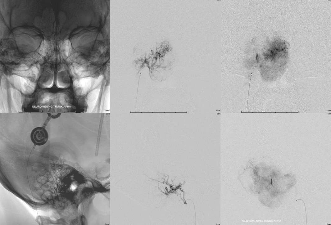 Hemangiopericytoma Embolization and Resection