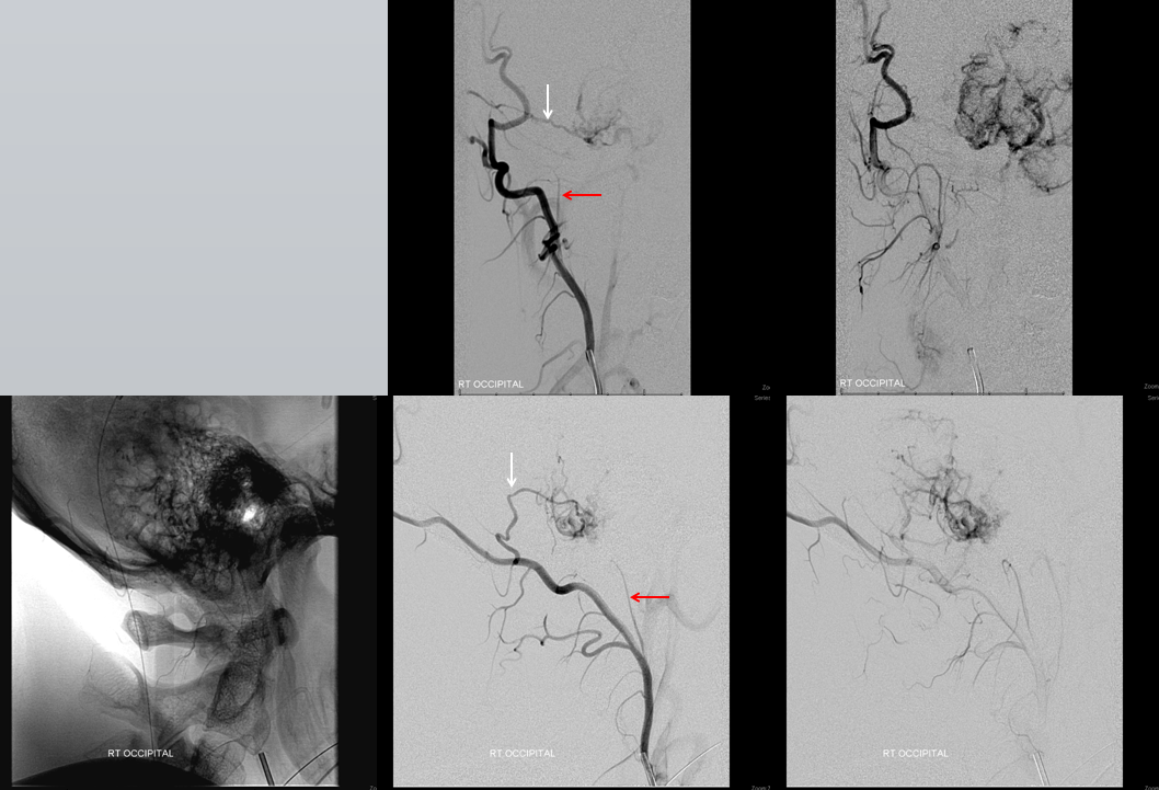 Hemangiopericytoma Embolization and Resection