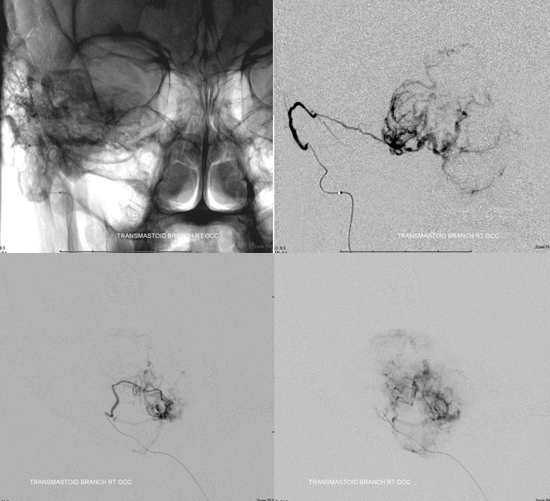 Hemangiopericytoma Embolization and Resection