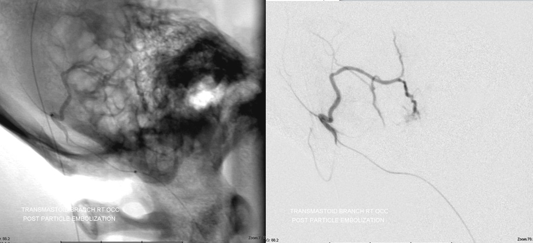 Hemangiopericytoma Embolization and Resection