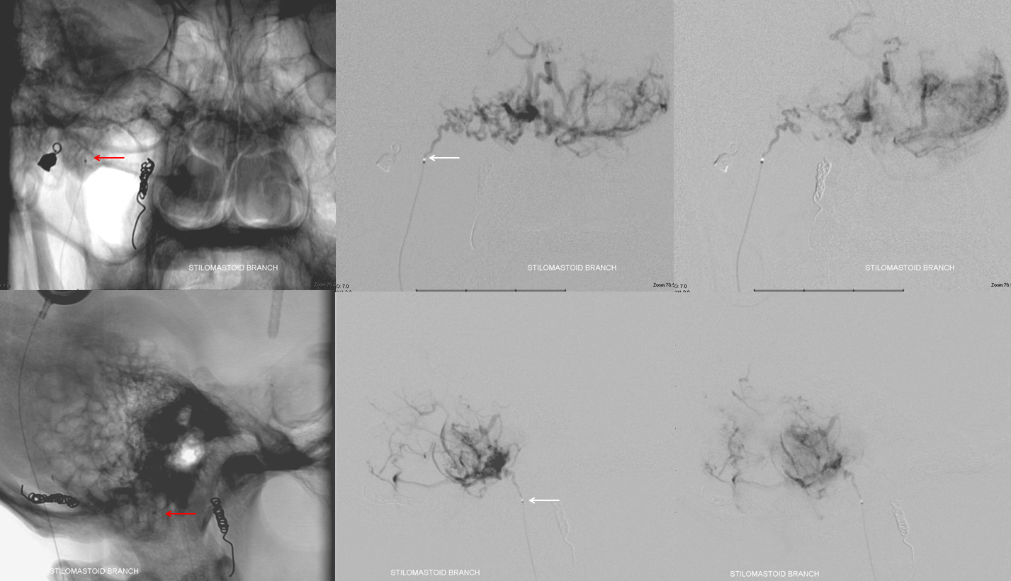 Hemangiopericytoma Embolization and Resection