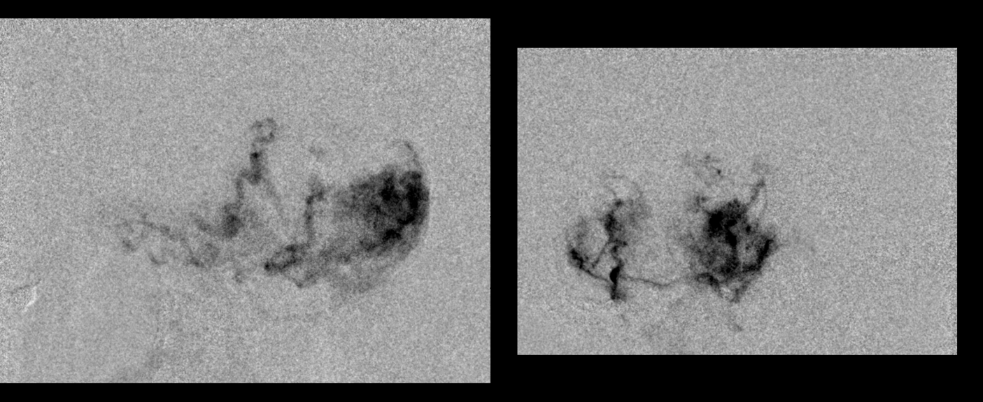 Hemangiopericytoma Embolization and Resection