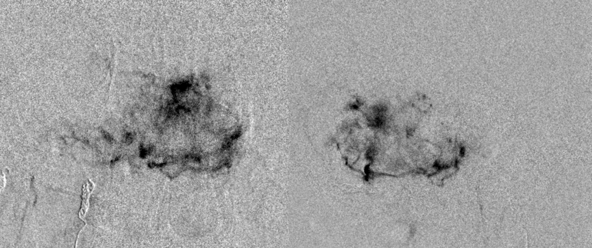 Hemangiopericytoma Embolization and Resection