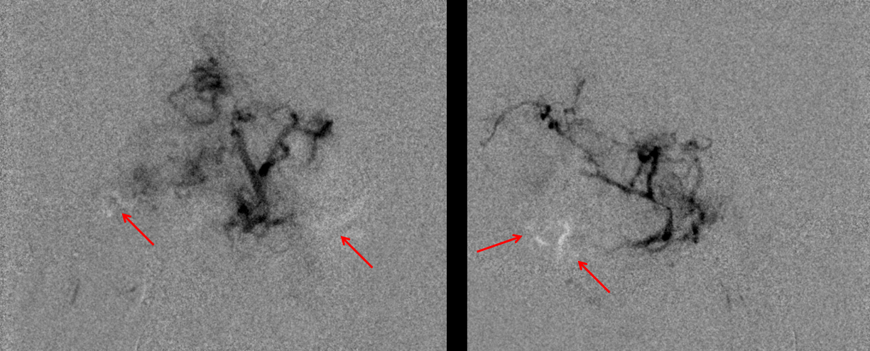 Hemangiopericytoma Embolization and Resection