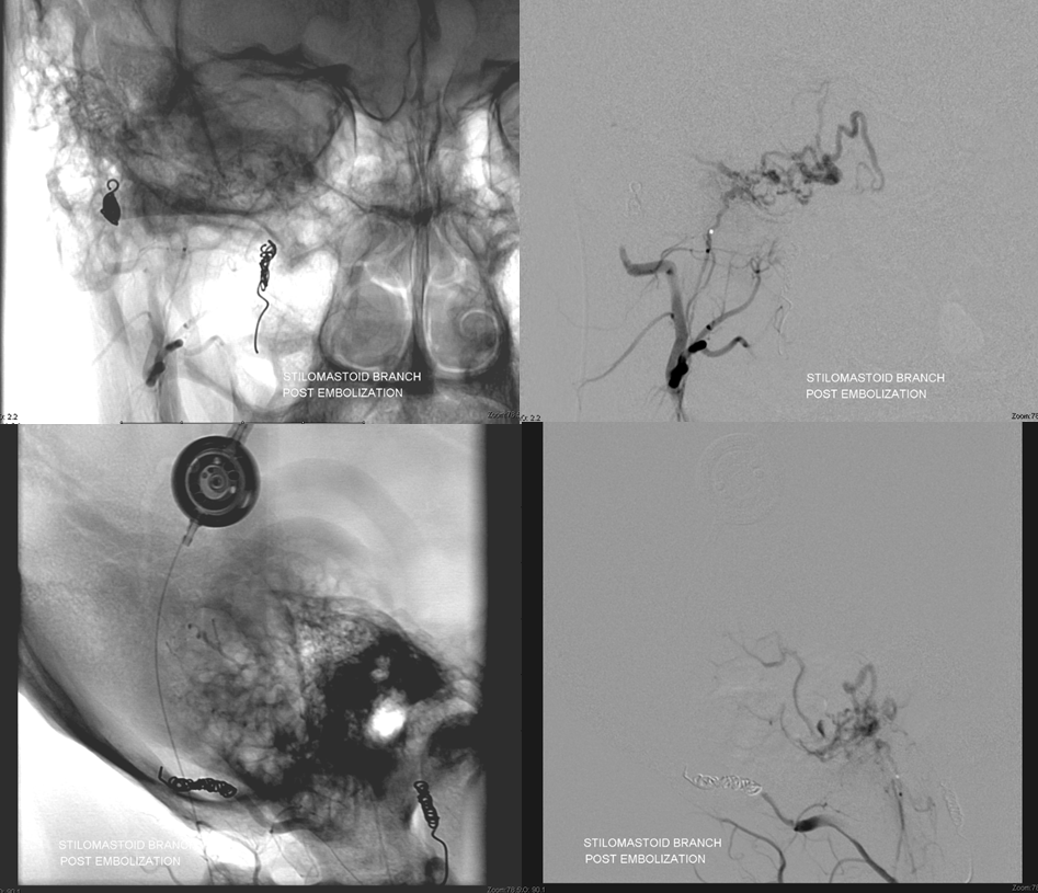 Hemangiopericytoma Embolization and Resection