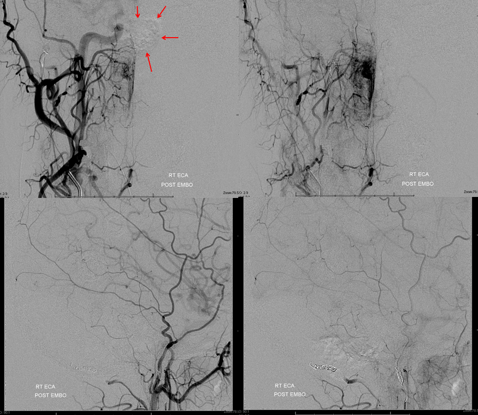 Hemangiopericytoma Embolization and Resection