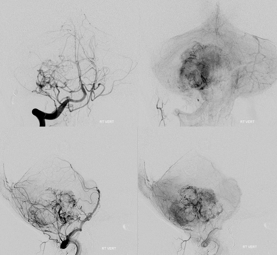 Hemangiopericytoma Embolization and Resection