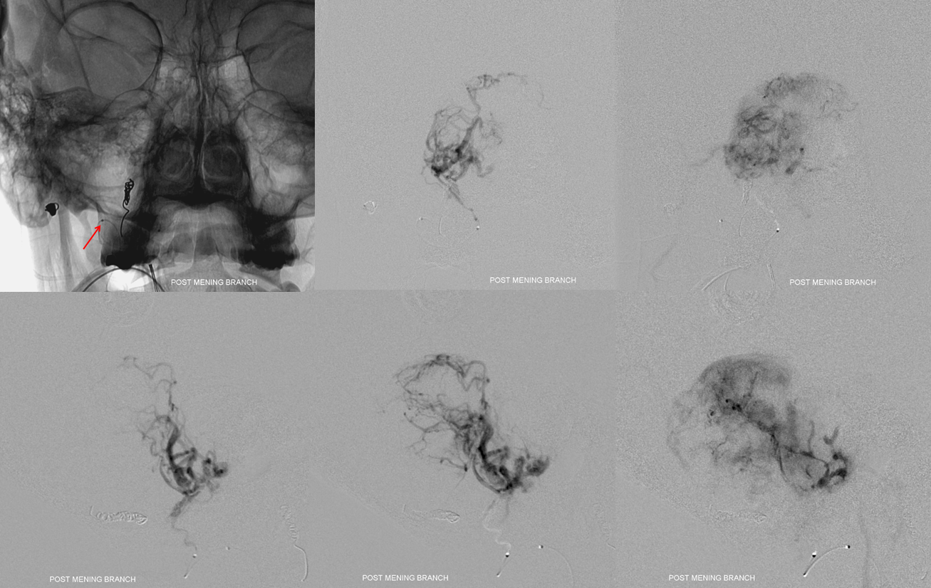 Hemangiopericytoma Embolization and Resection