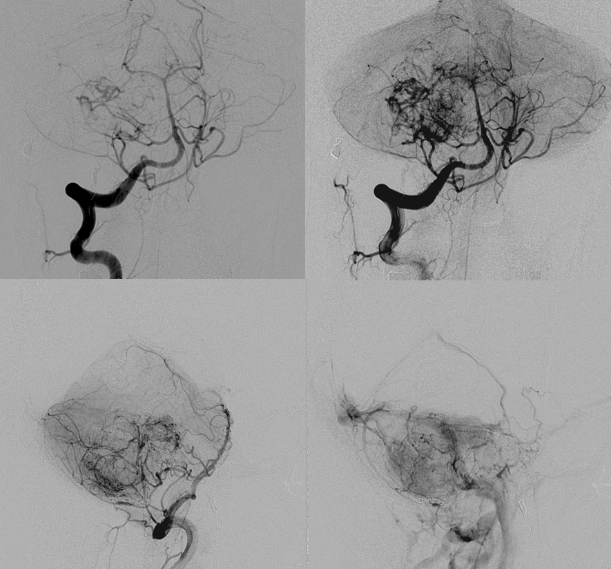 Hemangiopericytoma Embolization and Resection