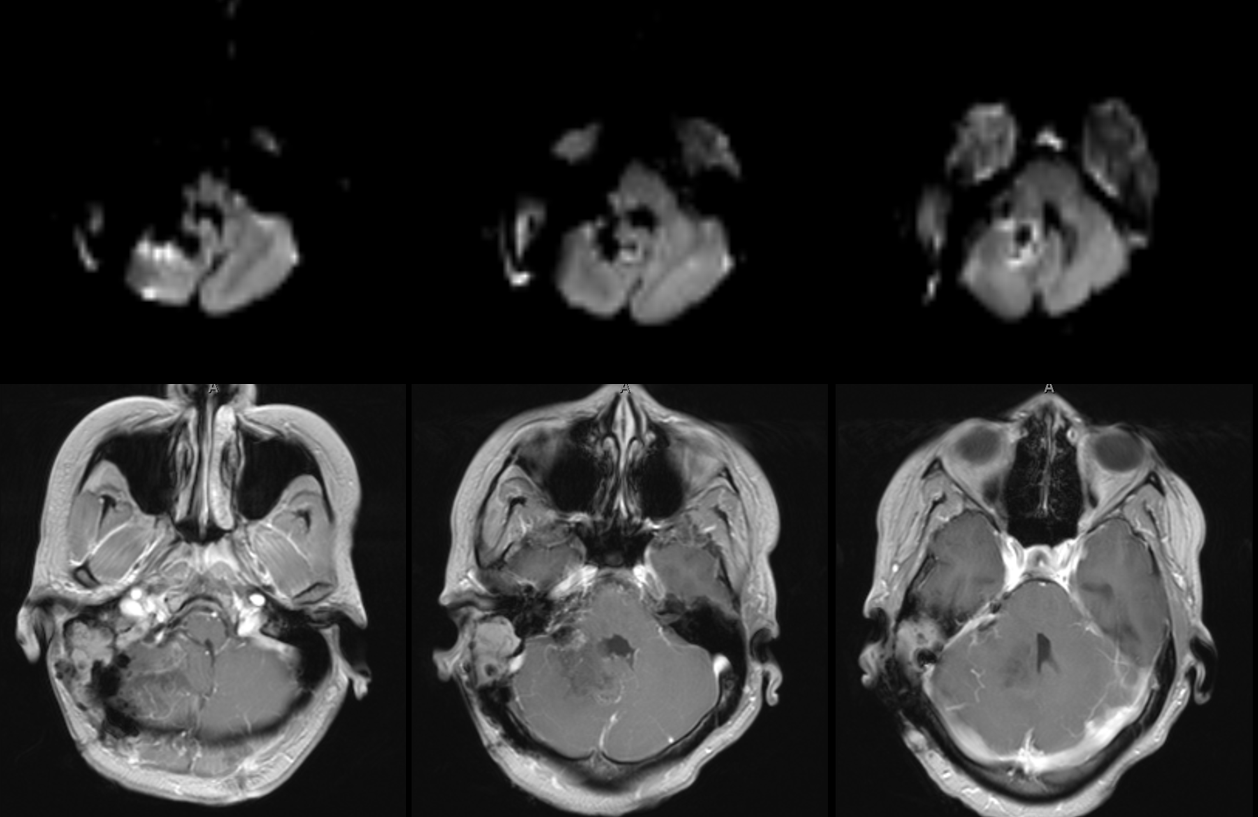 Hemangiopericytoma Embolization and Resection