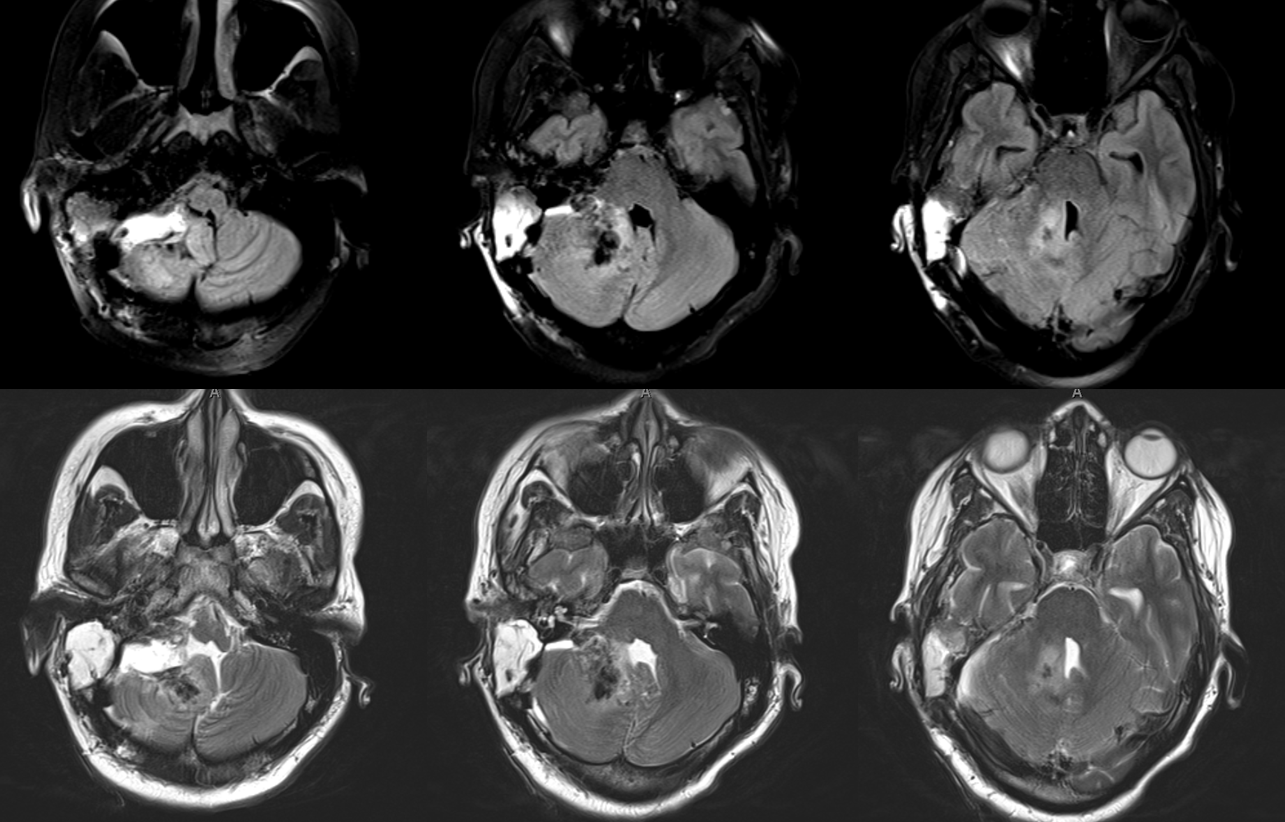 Hemangiopericytoma Embolization and Resection