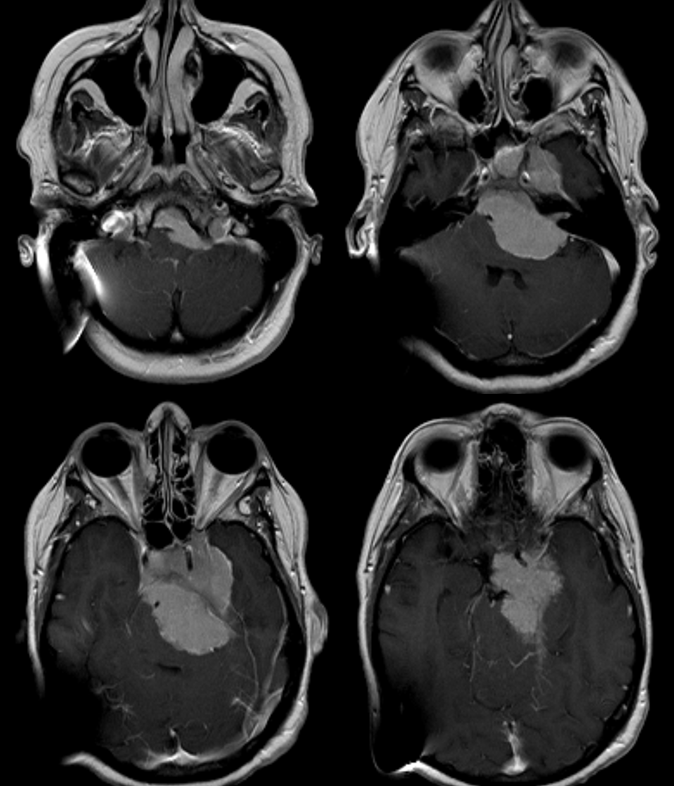 Meningioma embolization