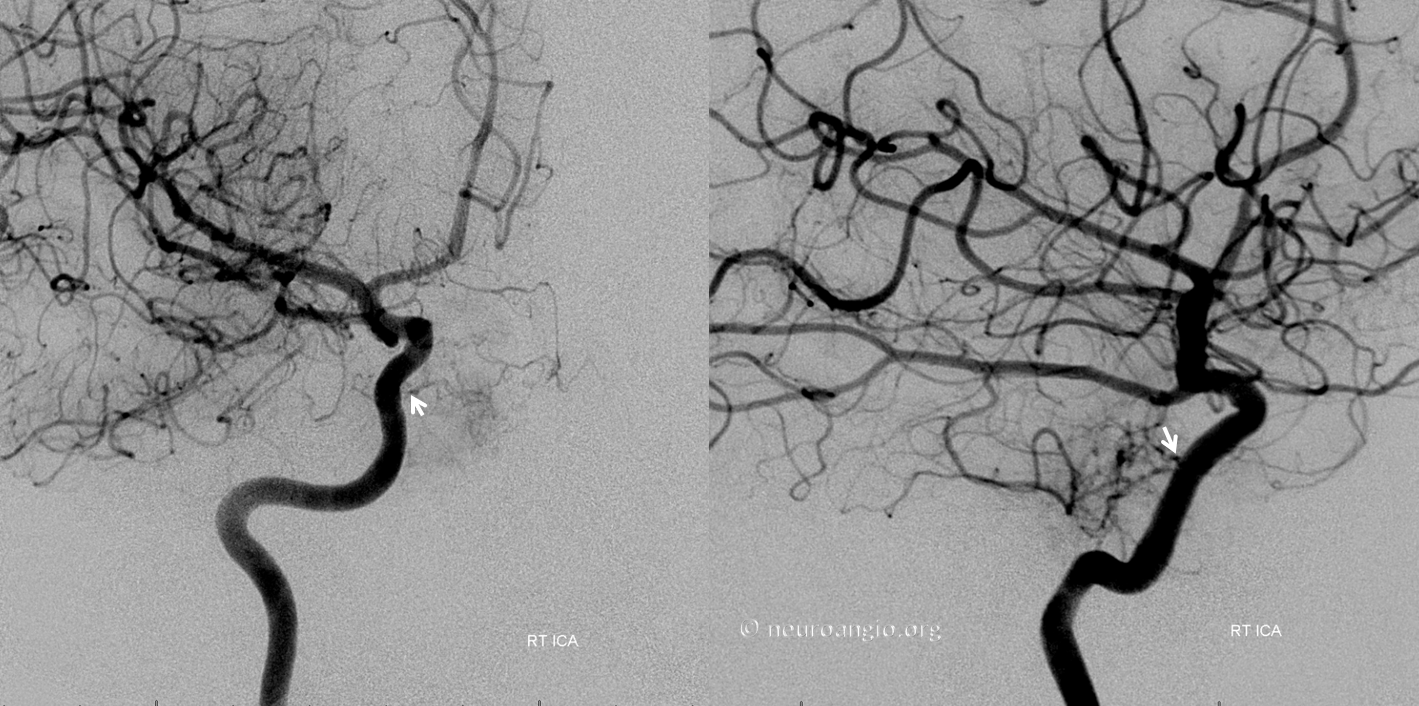 Meningioma embolization