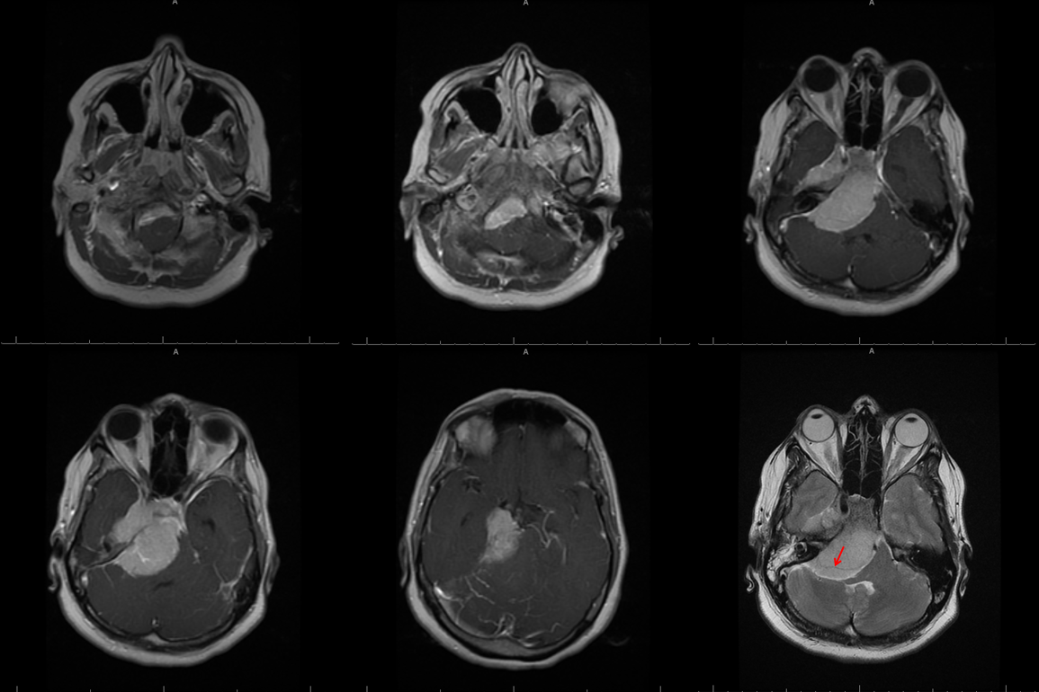 Petroclival Meningioma Embolization