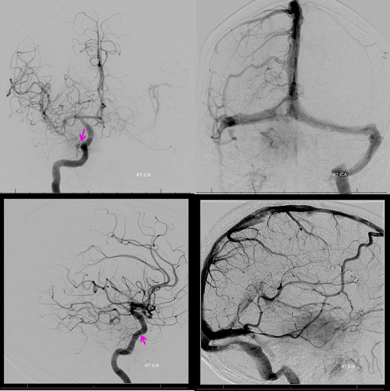 Petroclival Meningioma Embolization