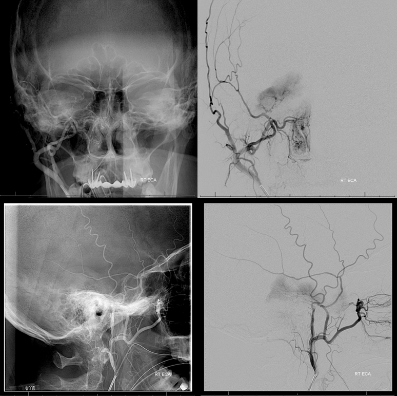 Petroclival Meningioma Embolization