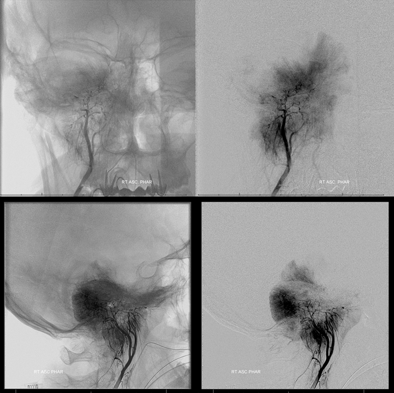 Petroclival Meningioma Embolization