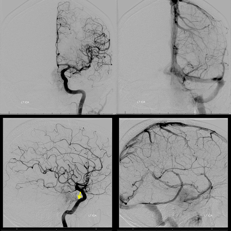 Petroclival Meningioma Embolization