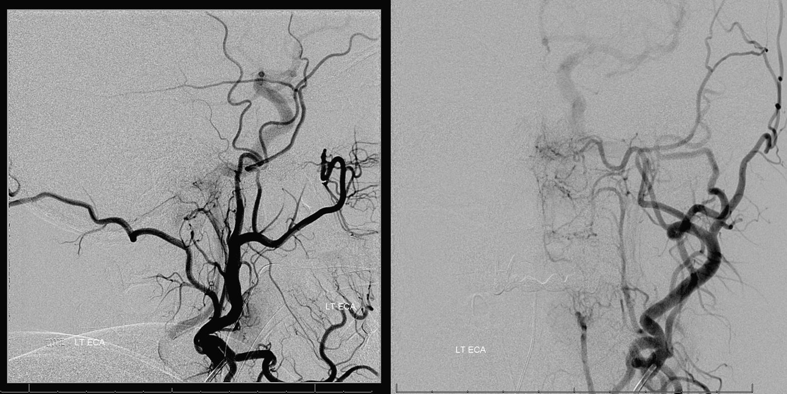 Petroclival Meningioma Embolization