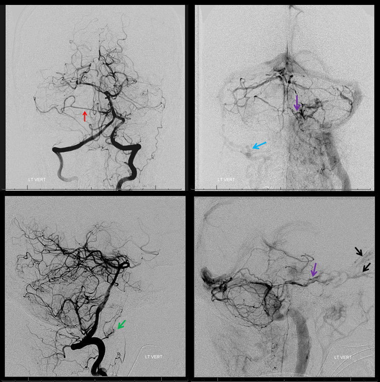 Petroclival Meningioma Embolization