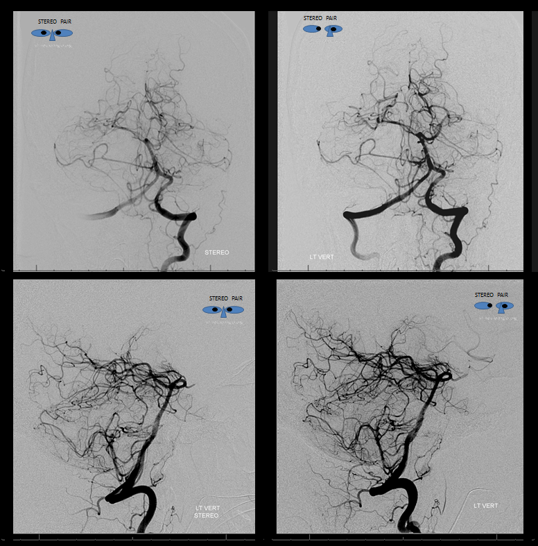 Petroclival Meningioma Embolization