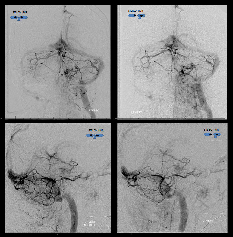 Petroclival Meningioma Embolization