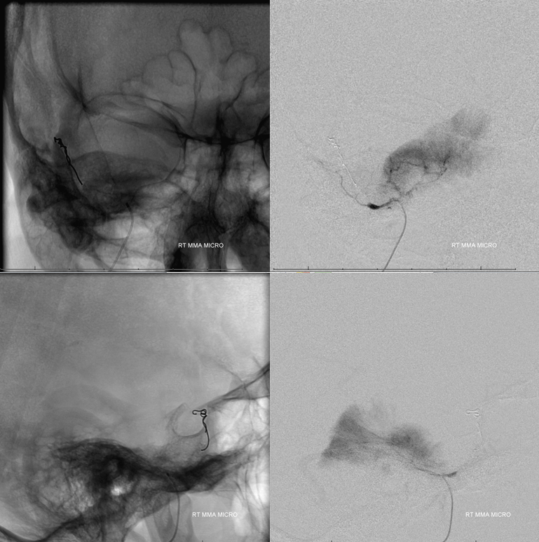 Petroclival Meningioma Embolization