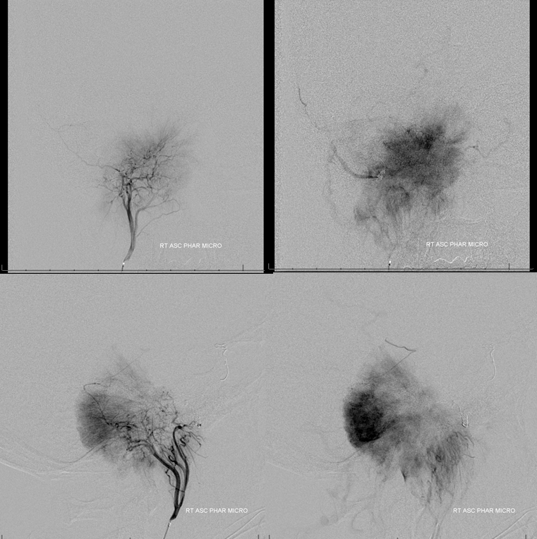 Petroclival Meningioma Embolization