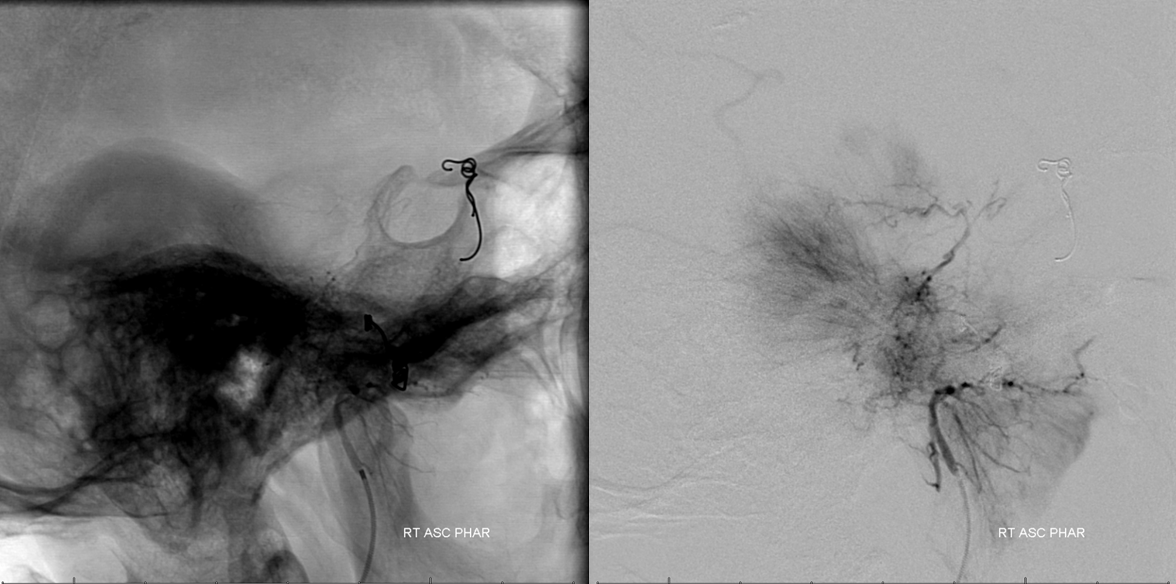 Petroclival Meningioma Embolization