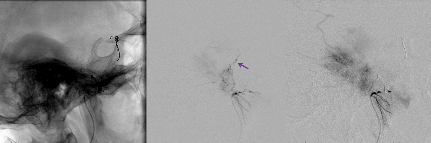 Petroclival Meningioma Embolization