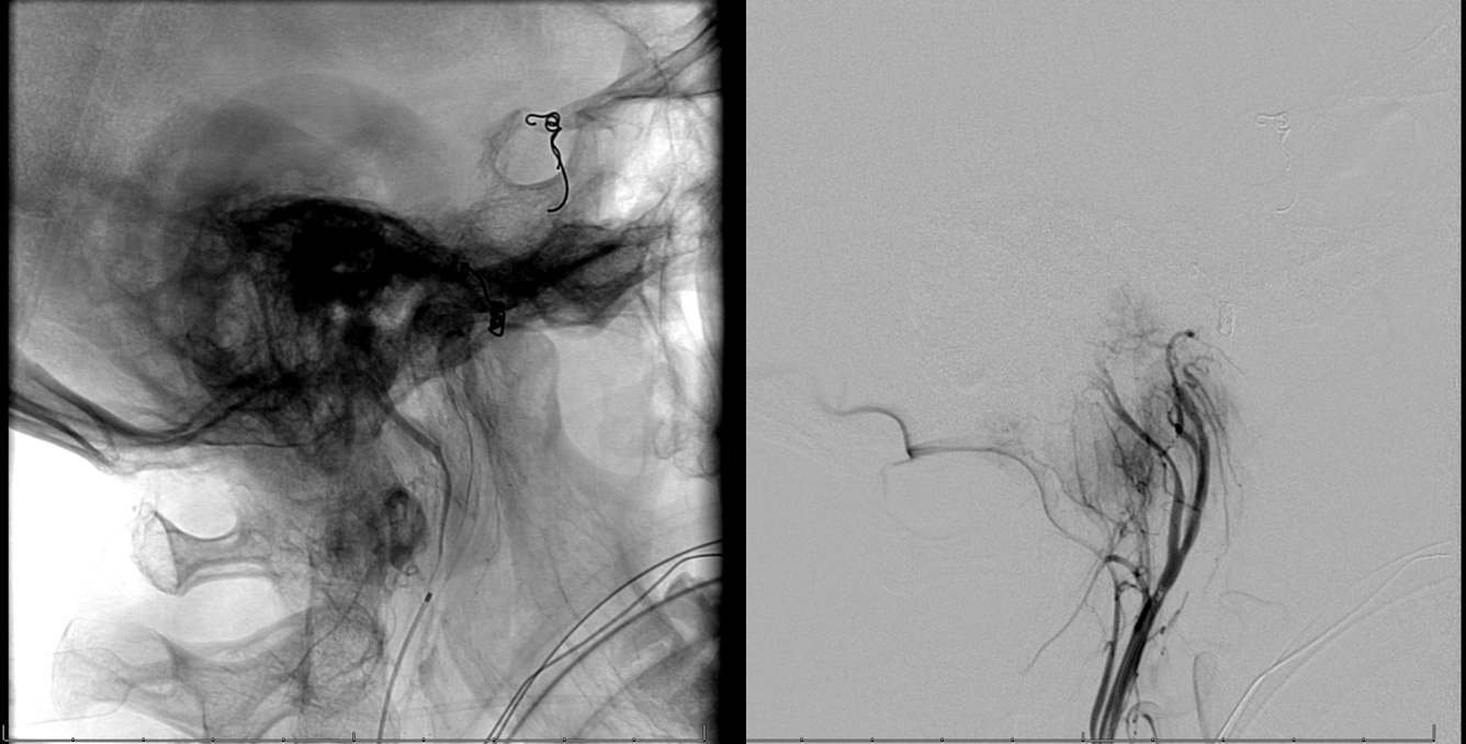 Petroclival Meningioma Embolization