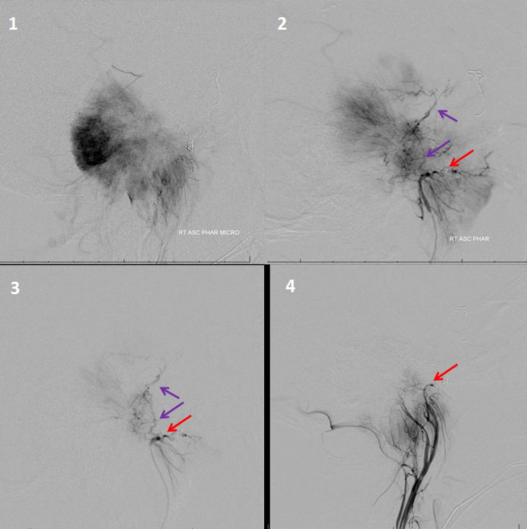 Petroclival Meningioma Embolization