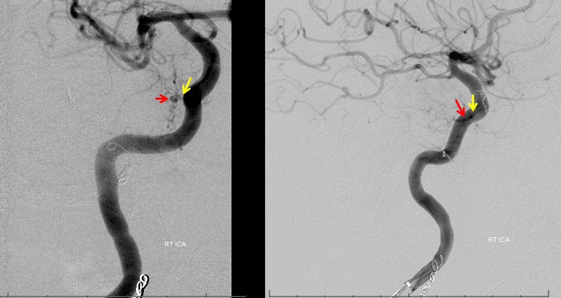 Petroclival Meningioma Embolization