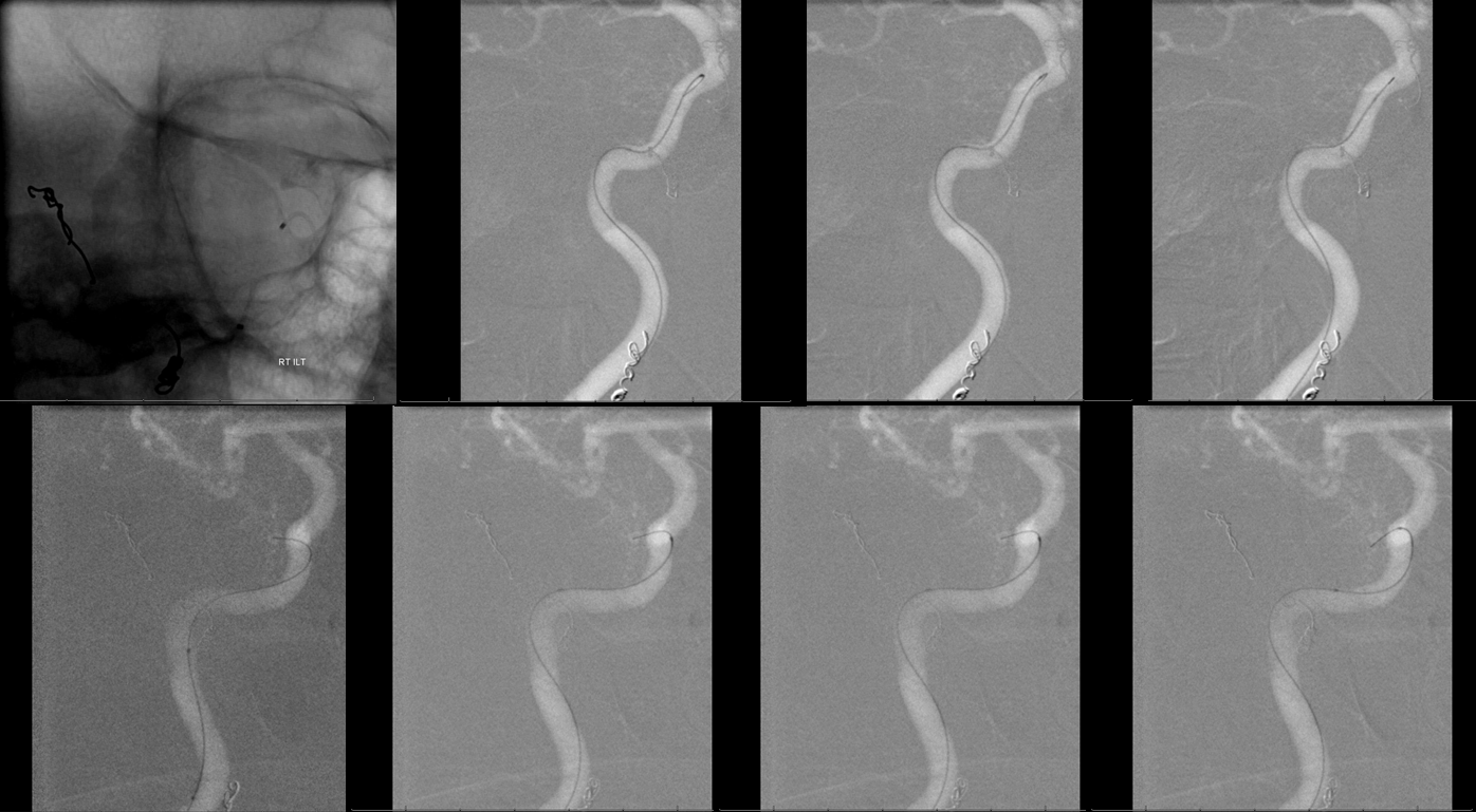 Petroclival Meningioma Embolization