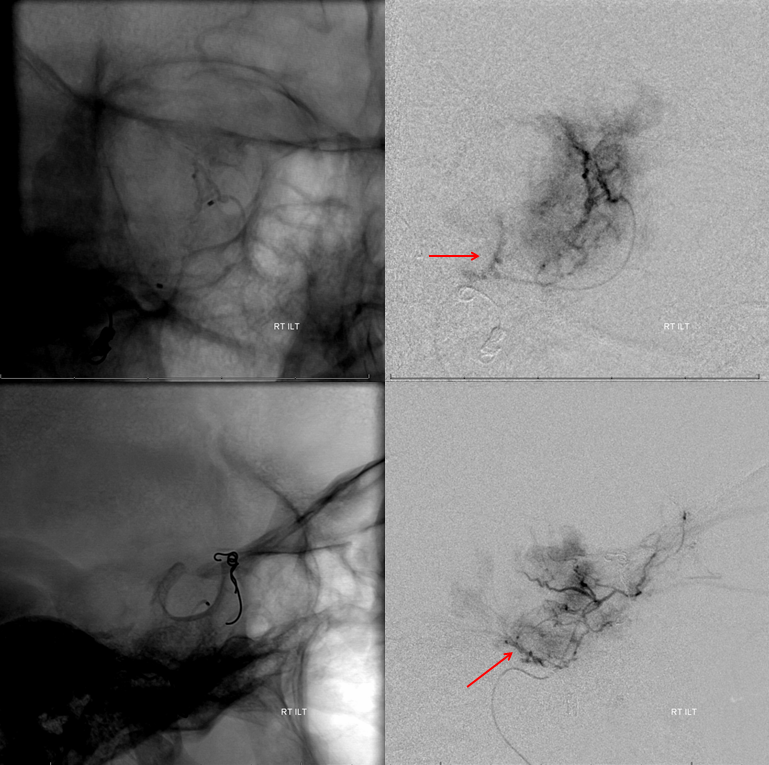 Petroclival Meningioma Embolization