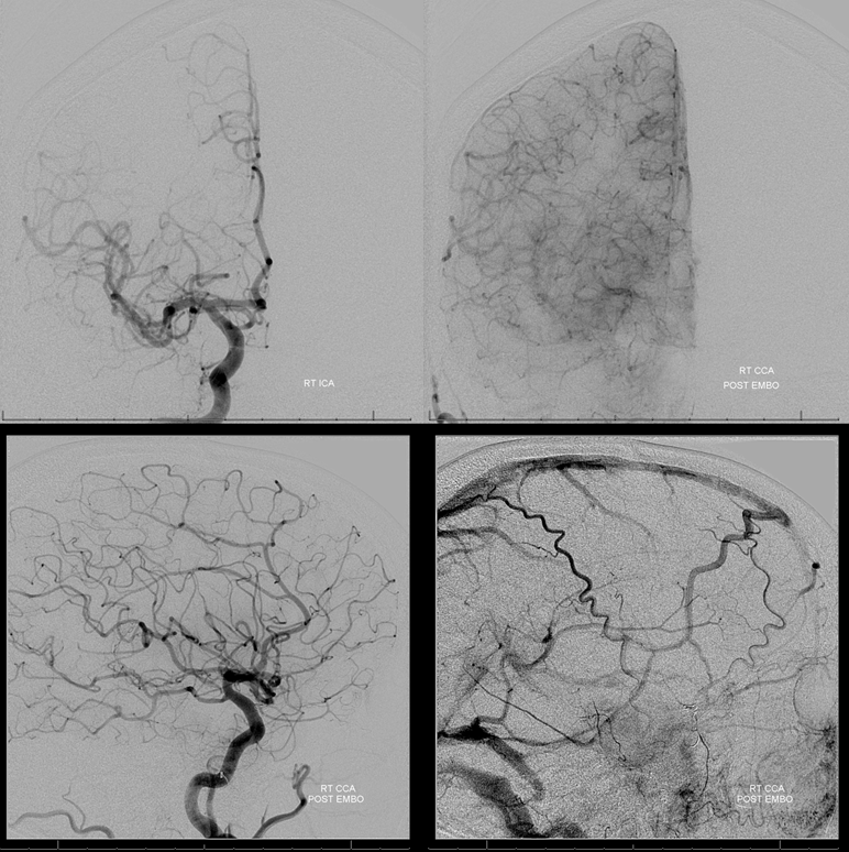 Petroclival Meningioma Embolization