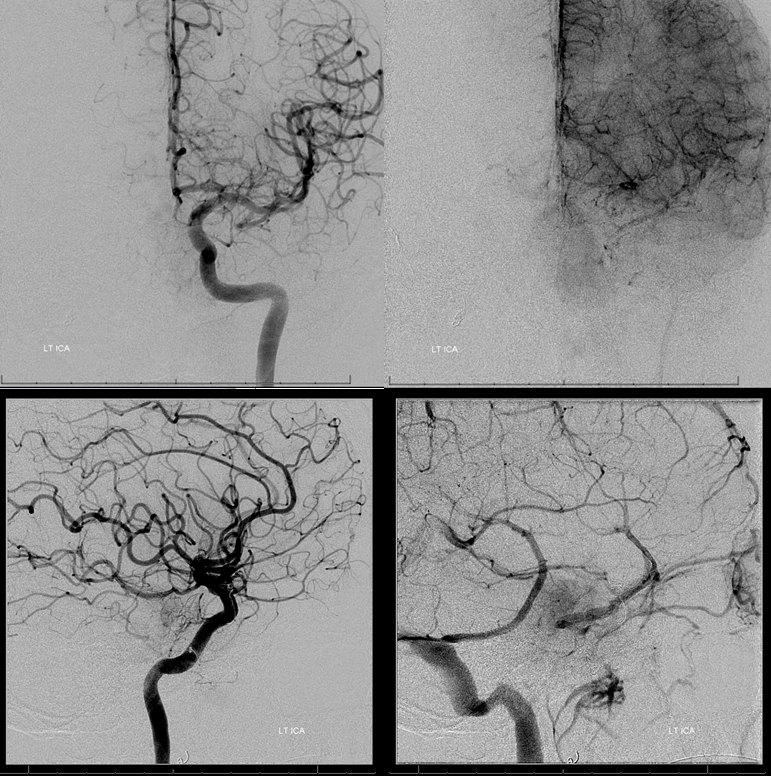 Petroclival Meningioma Embolization