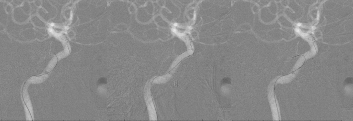 Petroclival Meningioma Embolization